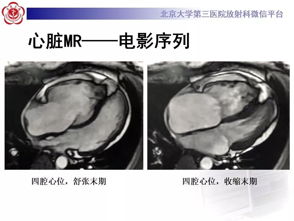 【病例】致心律失常性右室心肌病