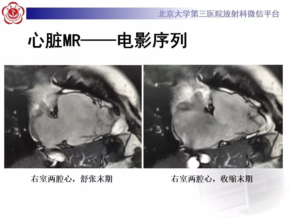 【病例】致心律失常性右室心肌病