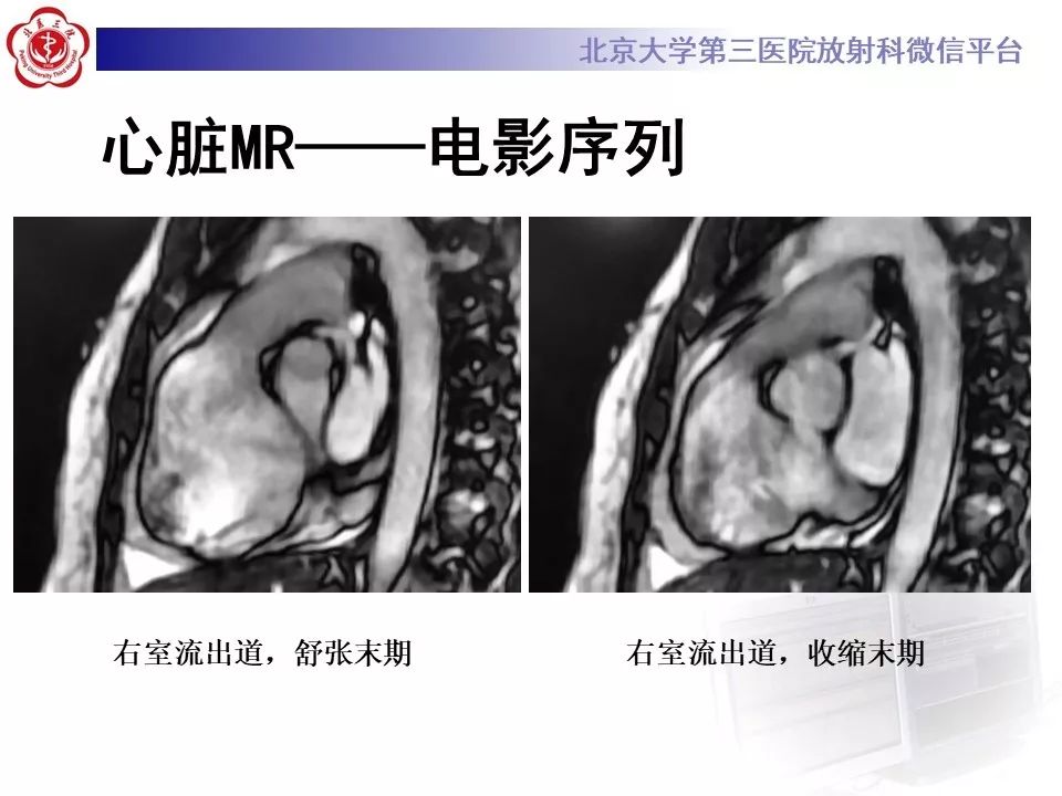 【病例】致心律失常性右室心肌病