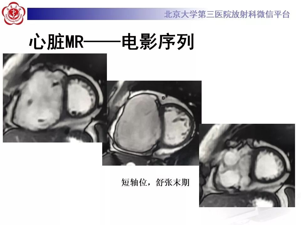 【病例】致心律失常性右室心肌病
