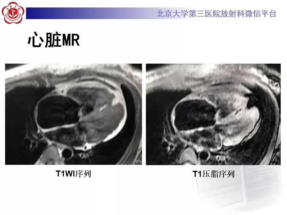 【病例】致心律失常性右室心肌病