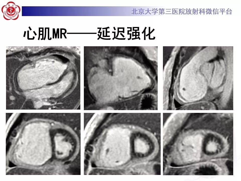 【病例】致心律失常性右室心肌病