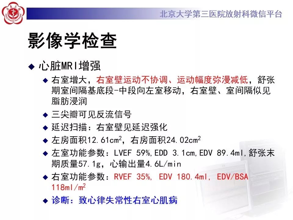 【病例】致心律失常性右室心肌病