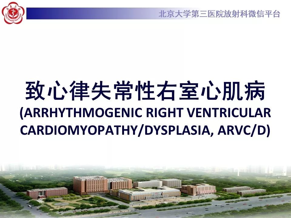 【病例】致心律失常性右室心肌病