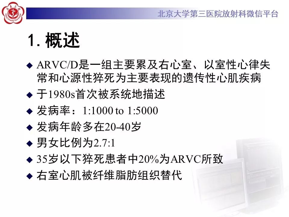 【病例】致心律失常性右室心肌病