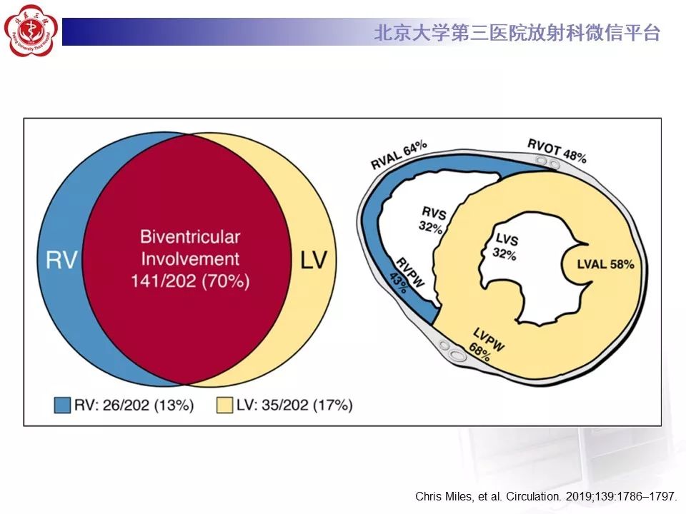 【病例】致心律失常性右室心肌病