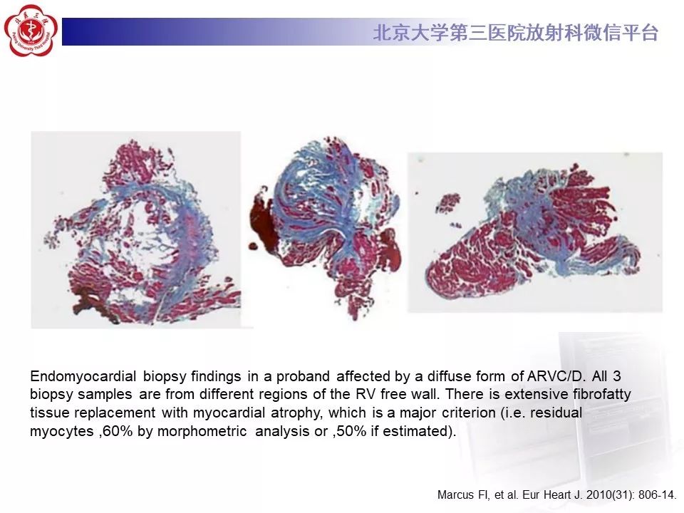 【病例】致心律失常性右室心肌病