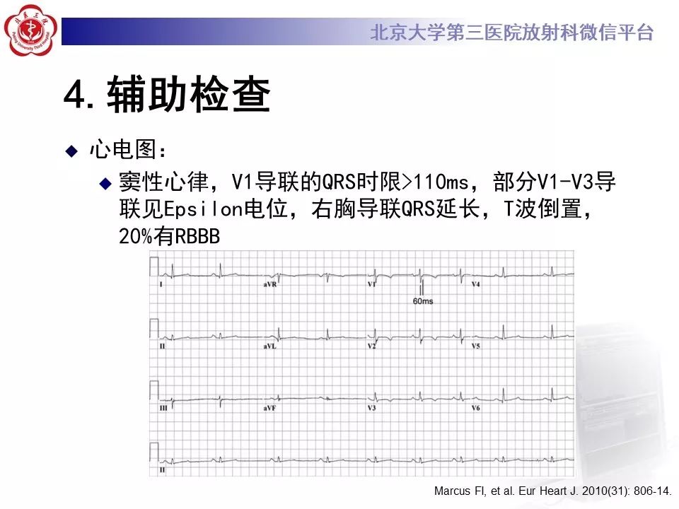 【病例】致心律失常性右室心肌病