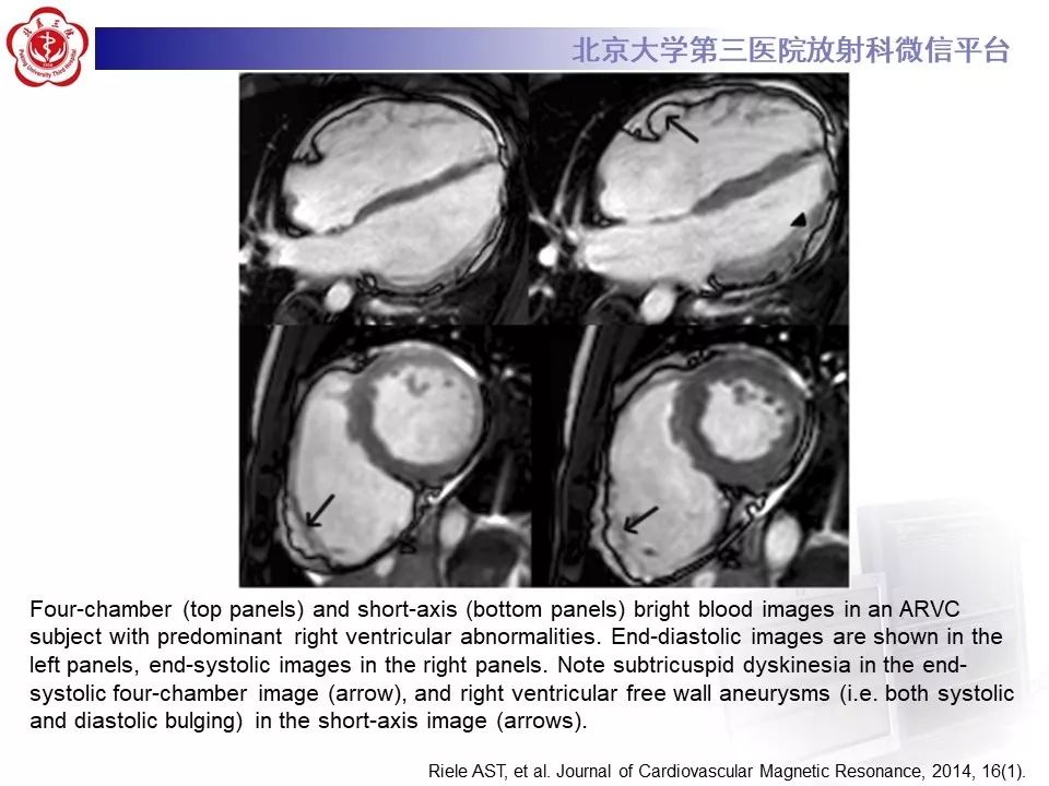【病例】致心律失常性右室心肌病