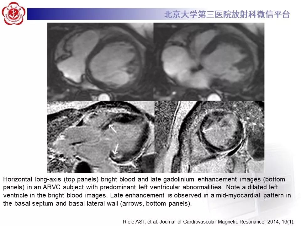【病例】致心律失常性右室心肌病