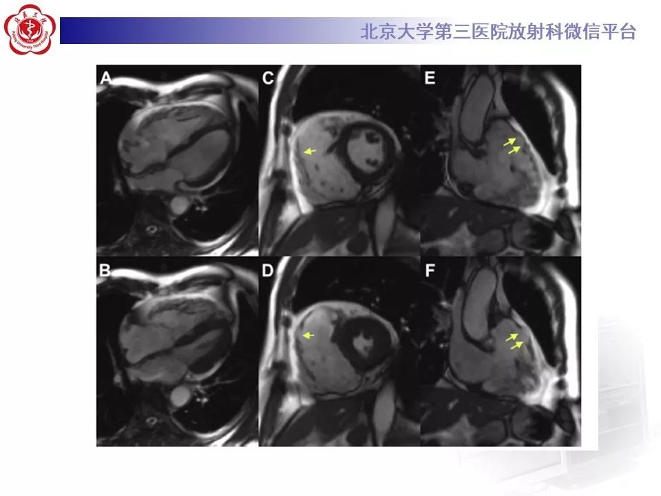 【病例】致心律失常性右室心肌病