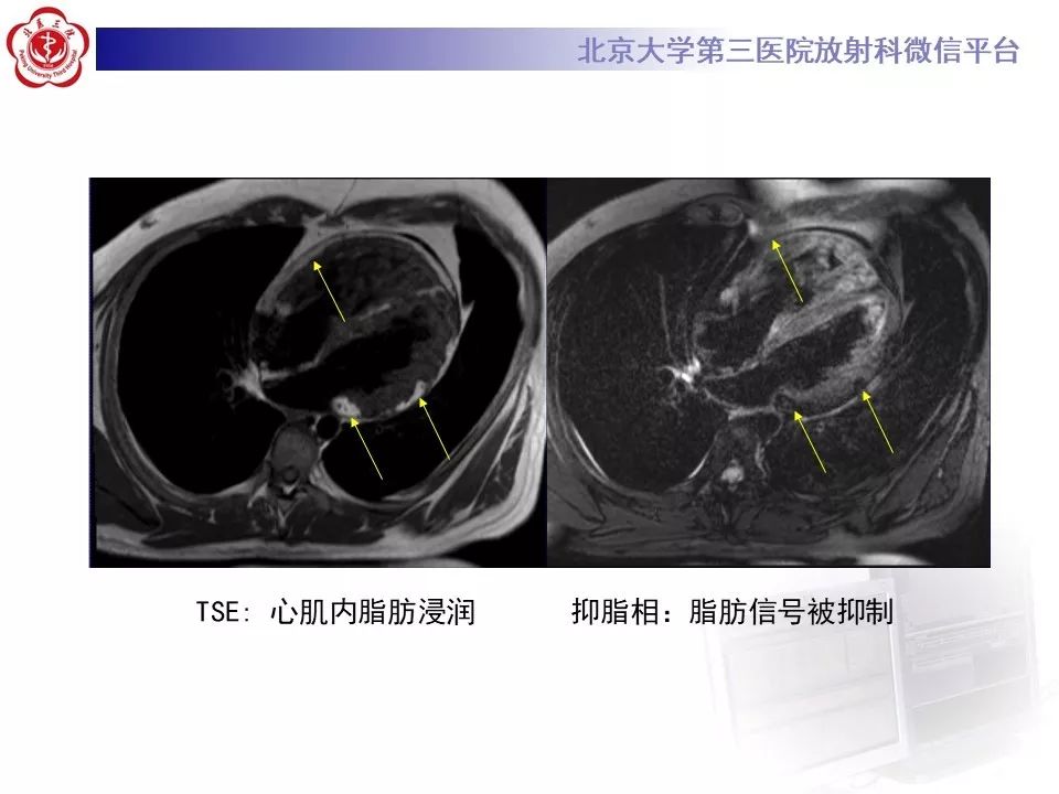 【病例】致心律失常性右室心肌病