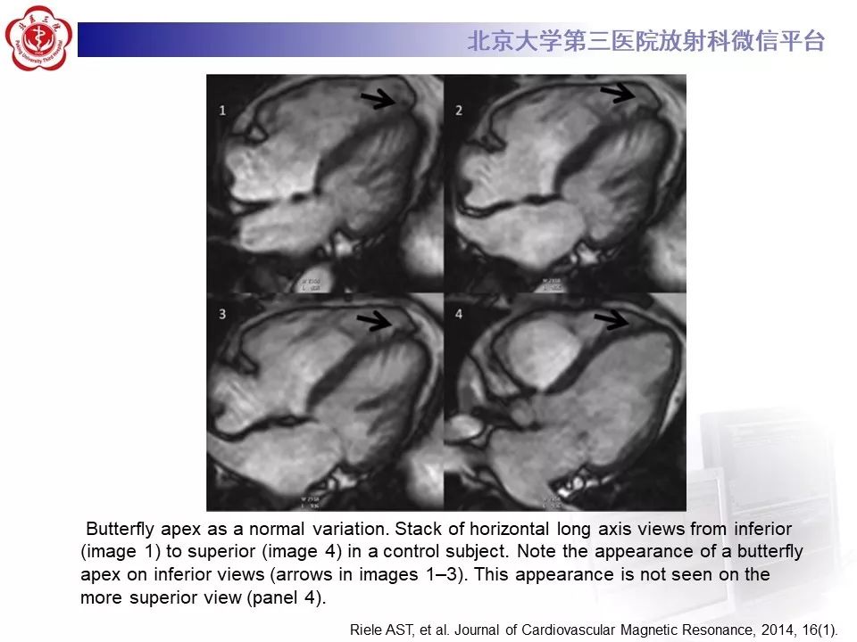 【病例】致心律失常性右室心肌病
