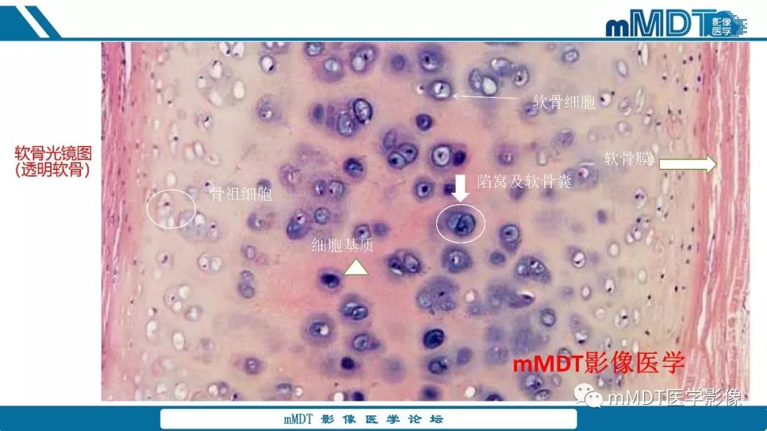 【PPT】成软骨性骨肿瘤影像诊断