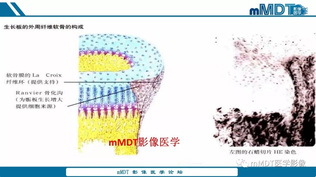 【PPT】成软骨性骨肿瘤影像诊断