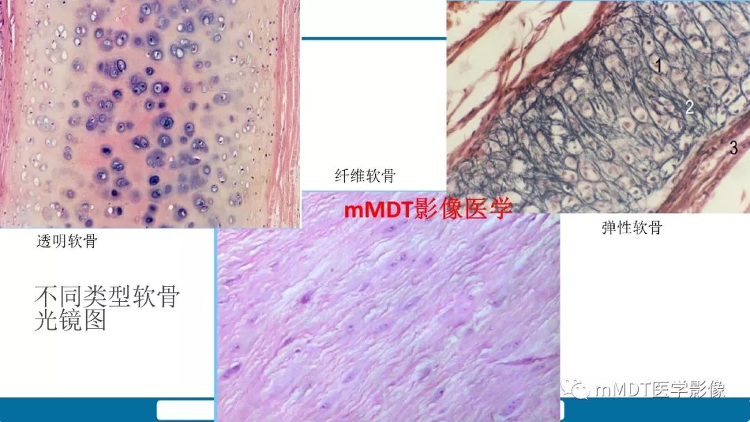 【PPT】成软骨性骨肿瘤影像诊断