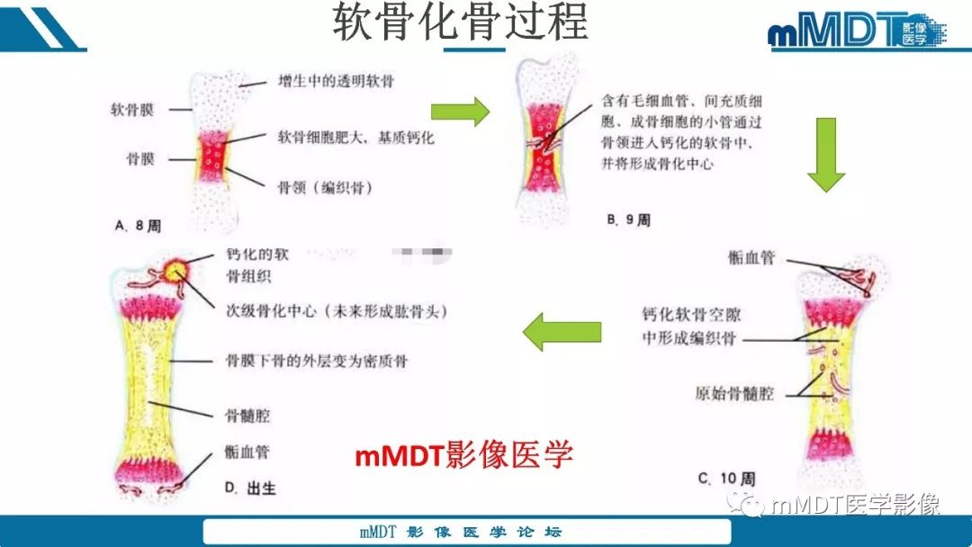 【PPT】成软骨性骨肿瘤影像诊断