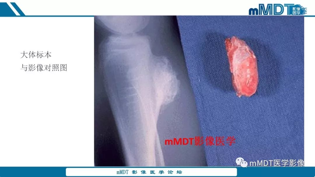 【PPT】成软骨性骨肿瘤影像诊断