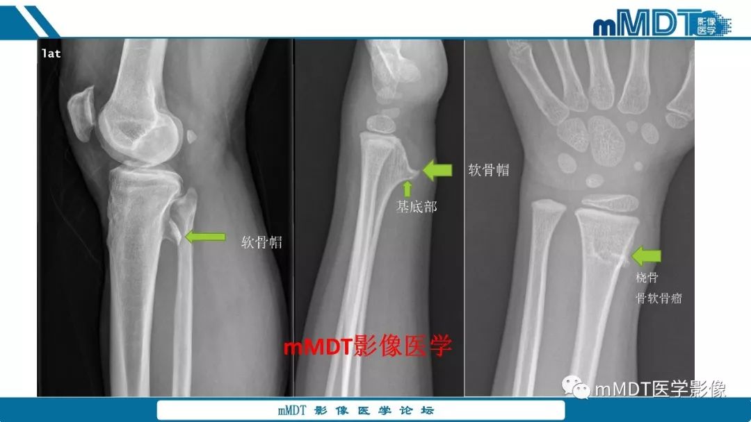 【PPT】成软骨性骨肿瘤影像诊断