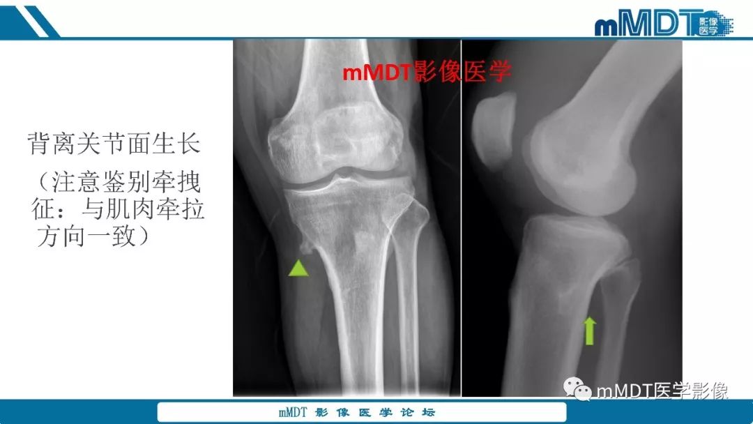 【PPT】成软骨性骨肿瘤影像诊断