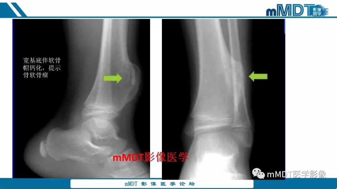 【PPT】成软骨性骨肿瘤影像诊断