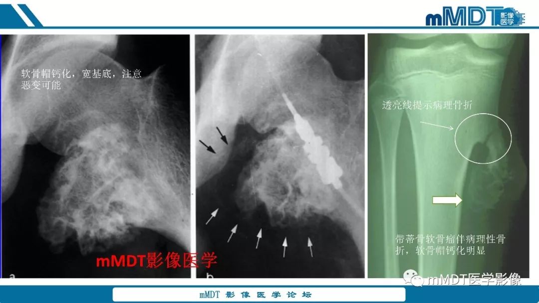 【PPT】成软骨性骨肿瘤影像诊断