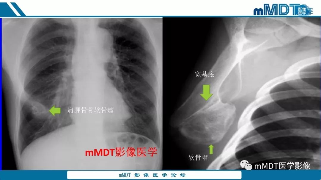 【PPT】成软骨性骨肿瘤影像诊断
