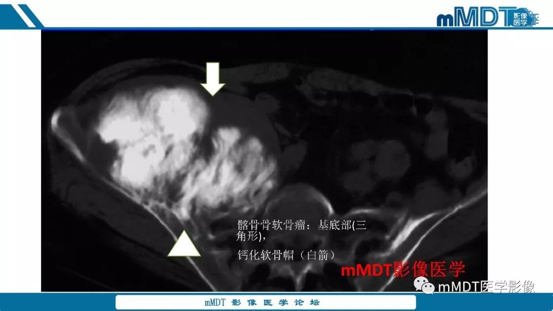 【PPT】成软骨性骨肿瘤影像诊断