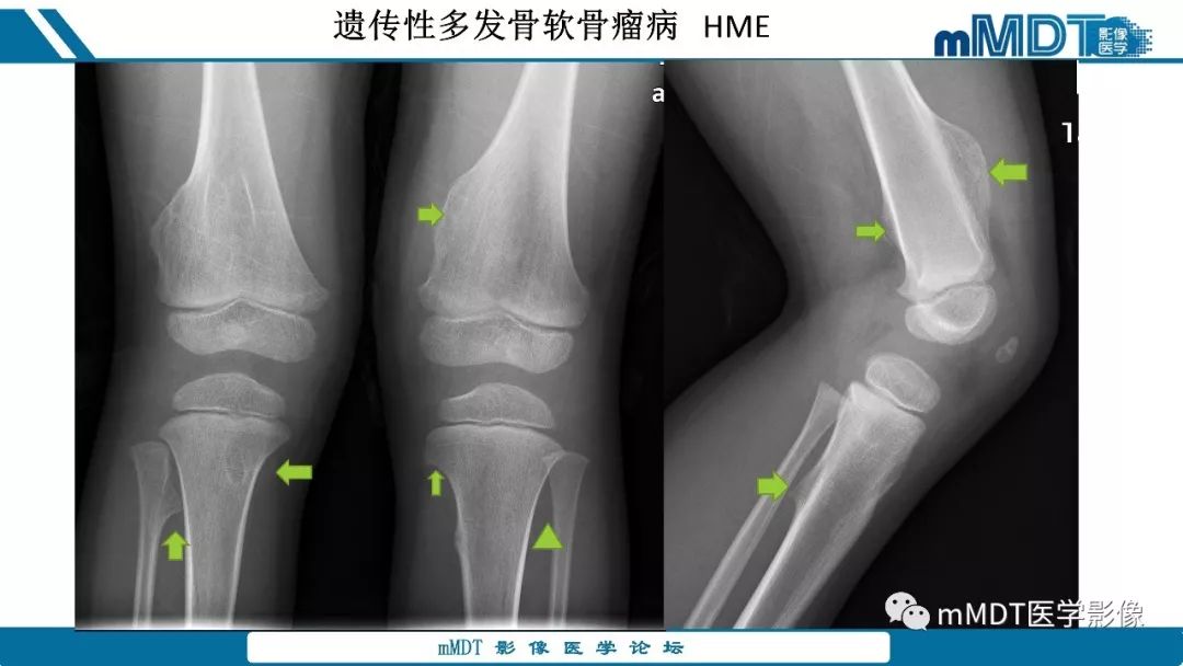 【PPT】成软骨性骨肿瘤影像诊断
