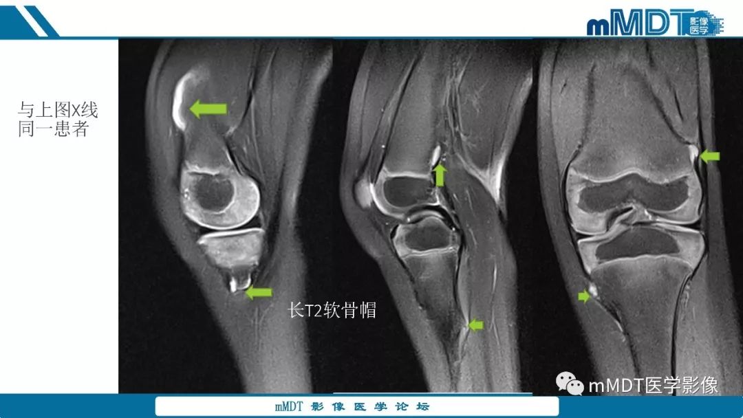 【PPT】成软骨性骨肿瘤影像诊断
