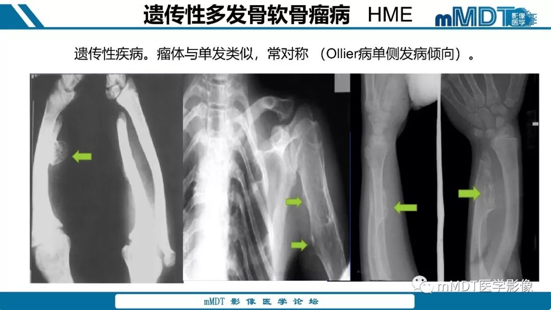 【PPT】成软骨性骨肿瘤影像诊断
