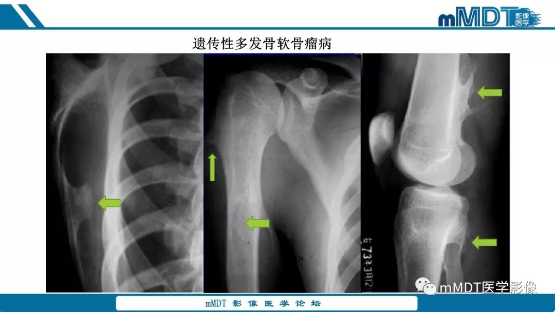 【PPT】成软骨性骨肿瘤影像诊断