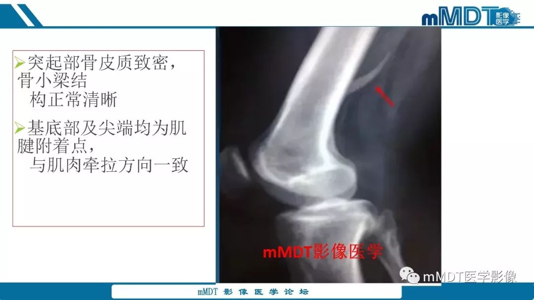 【PPT】成软骨性骨肿瘤影像诊断