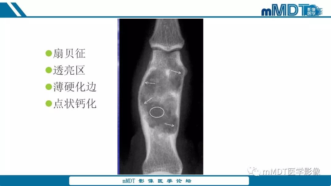 【PPT】成软骨性骨肿瘤影像诊断