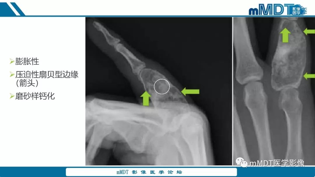 【PPT】成软骨性骨肿瘤影像诊断