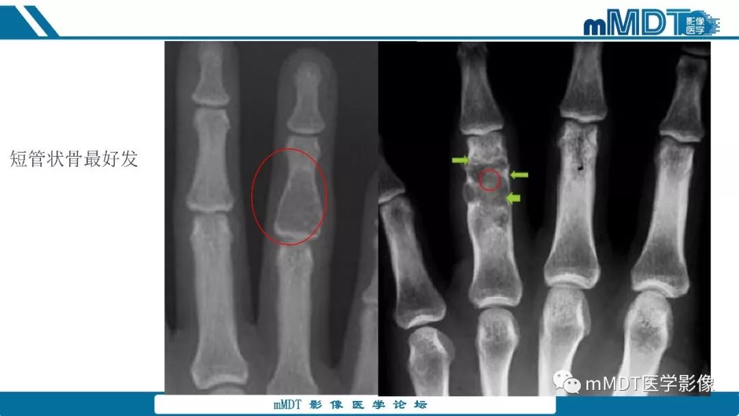 【PPT】成软骨性骨肿瘤影像诊断