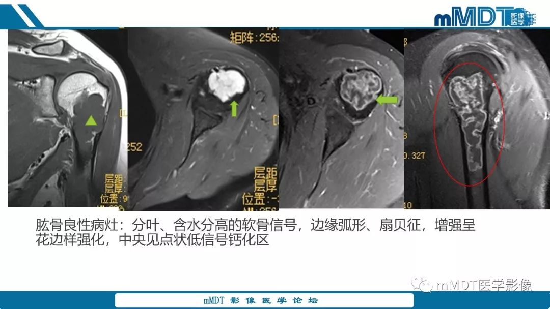 【PPT】成软骨性骨肿瘤影像诊断