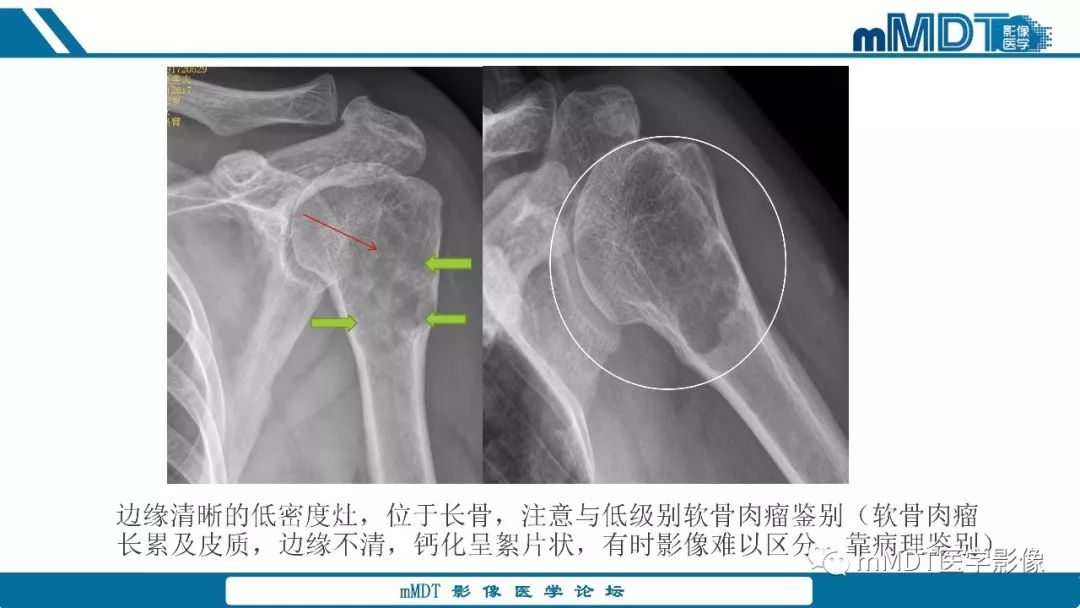 【PPT】成软骨性骨肿瘤影像诊断
