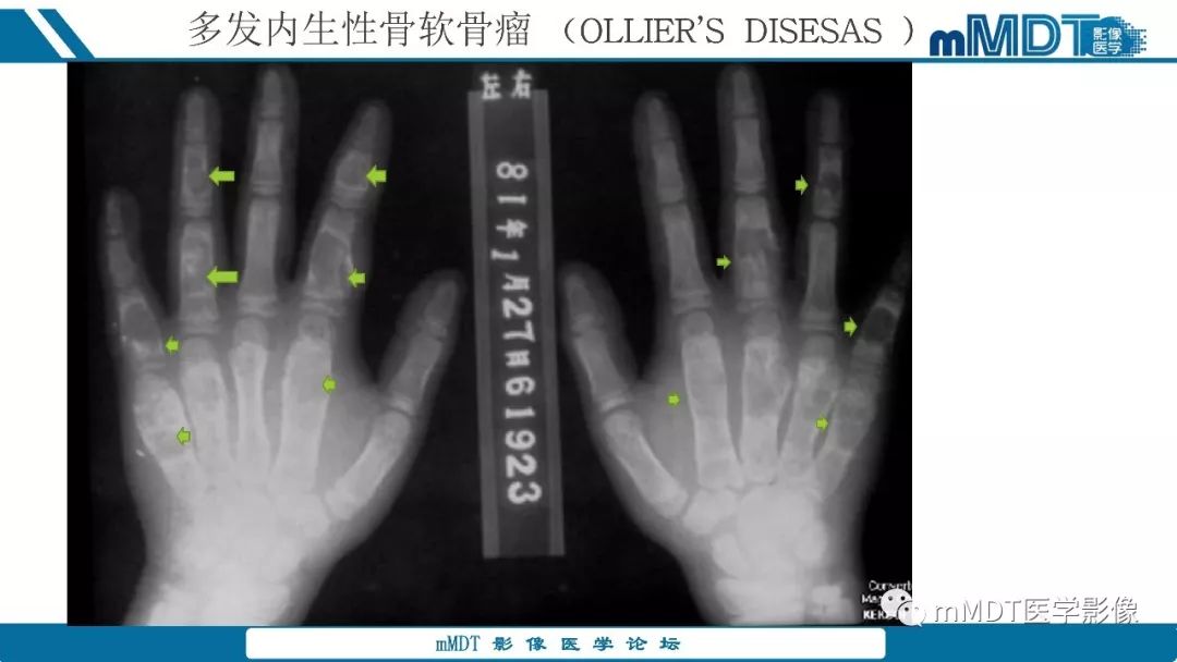 【PPT】成软骨性骨肿瘤影像诊断