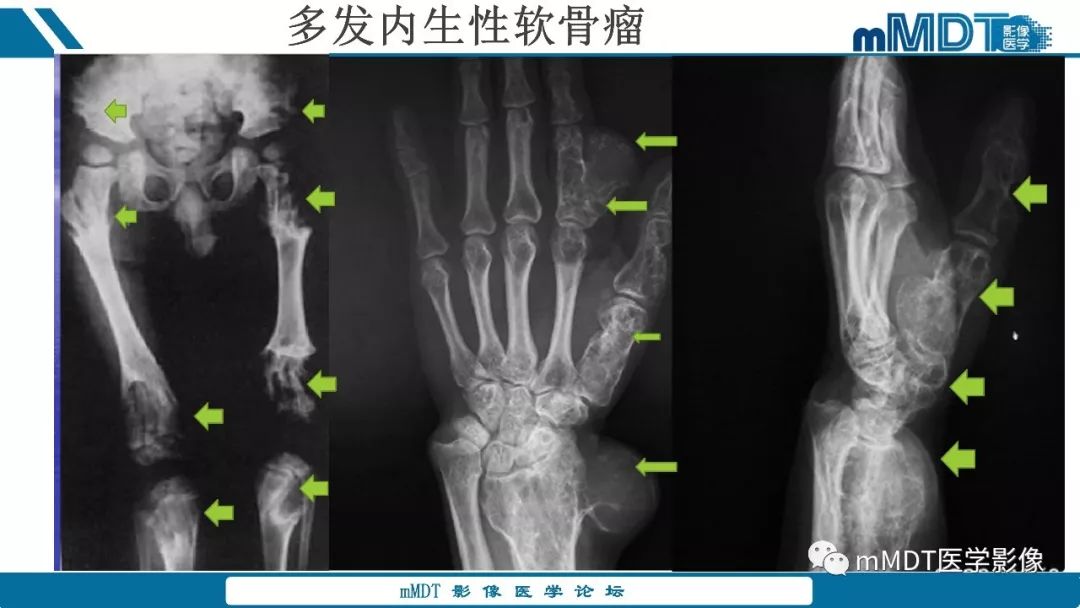 【PPT】成软骨性骨肿瘤影像诊断