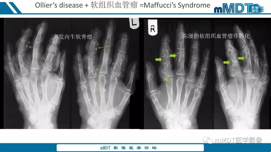 【PPT】成软骨性骨肿瘤影像诊断