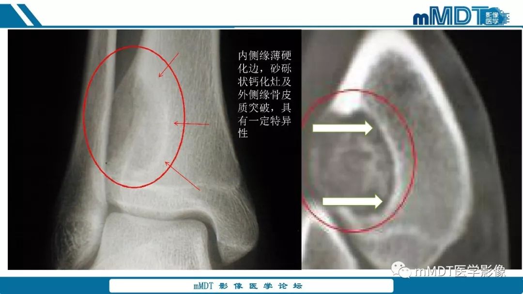 【PPT】成软骨性骨肿瘤影像诊断
