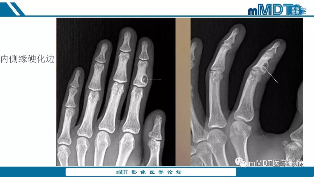 【PPT】成软骨性骨肿瘤影像诊断