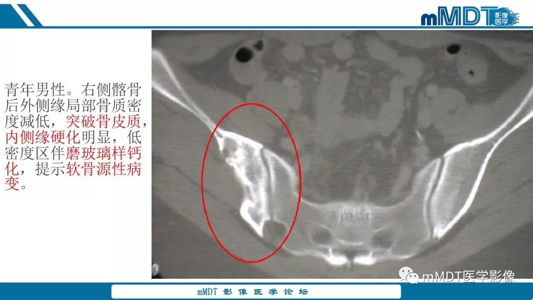 【PPT】成软骨性骨肿瘤影像诊断