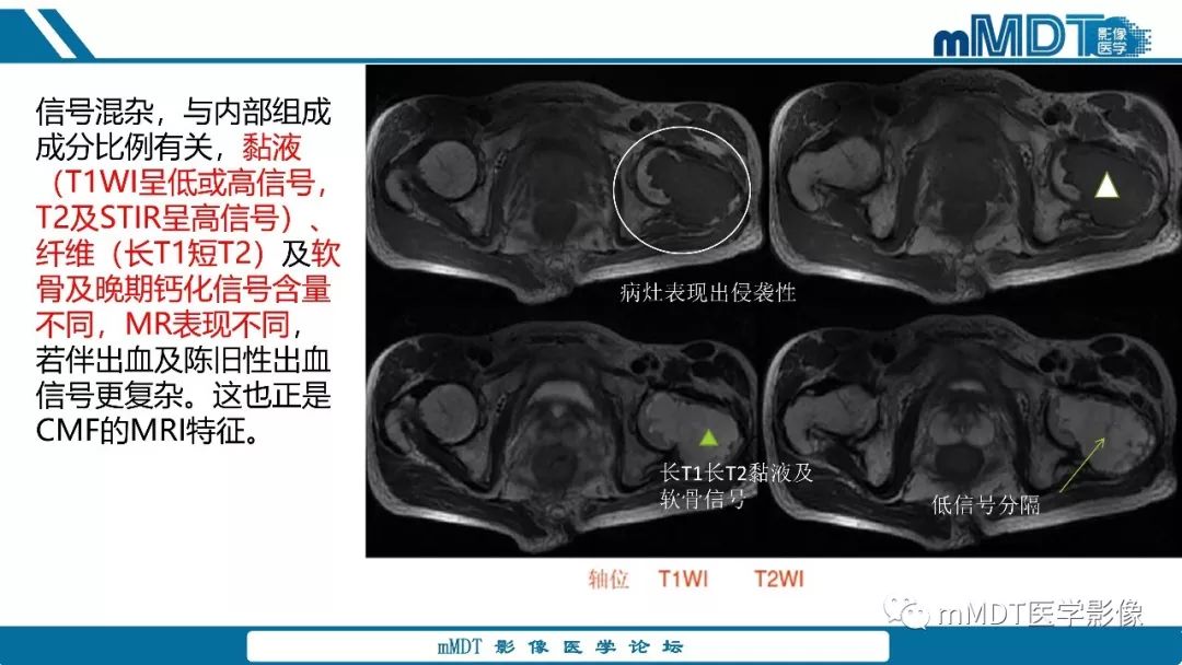 【PPT】成软骨性骨肿瘤影像诊断