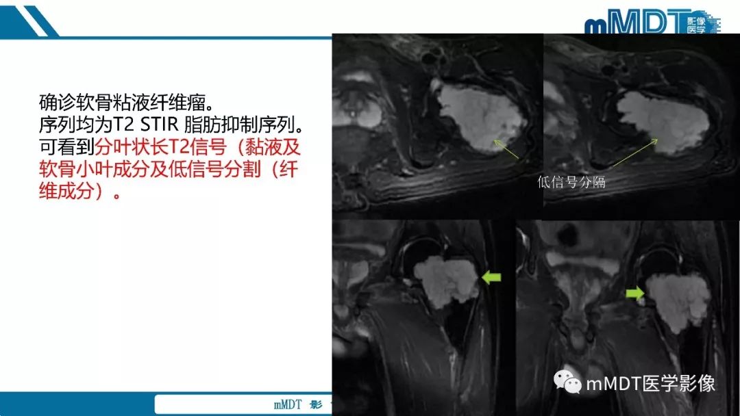【PPT】成软骨性骨肿瘤影像诊断