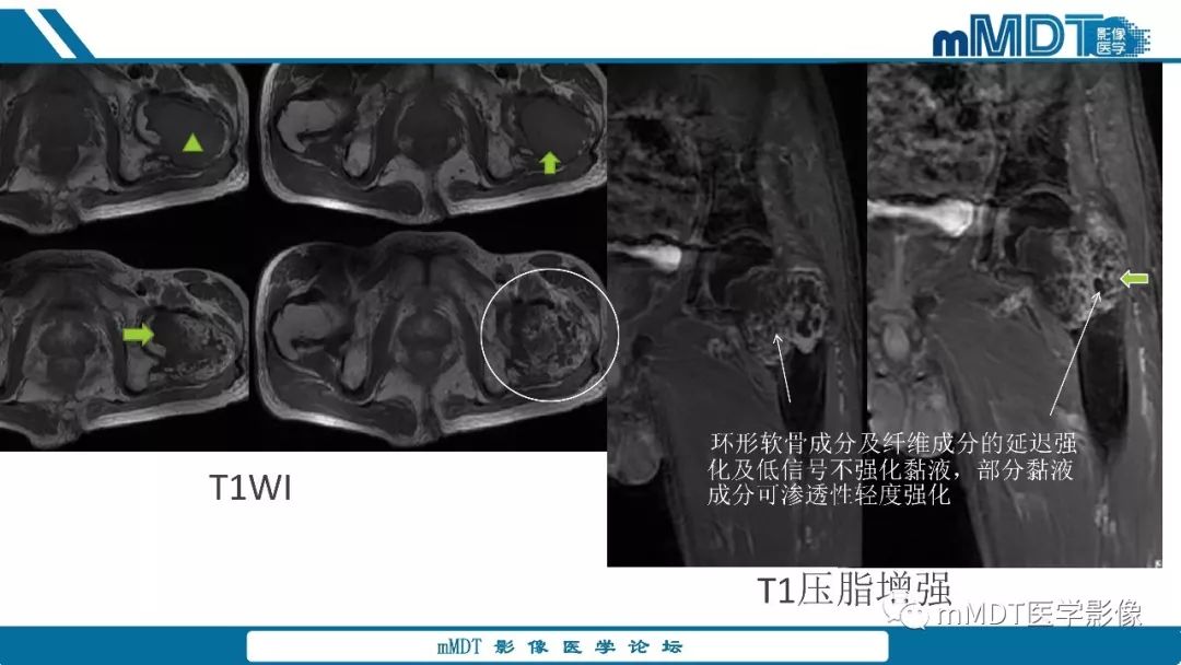 【PPT】成软骨性骨肿瘤影像诊断