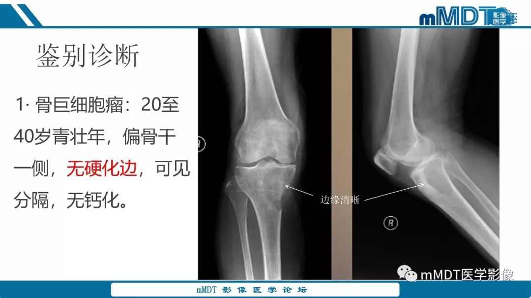 【PPT】成软骨性骨肿瘤影像诊断