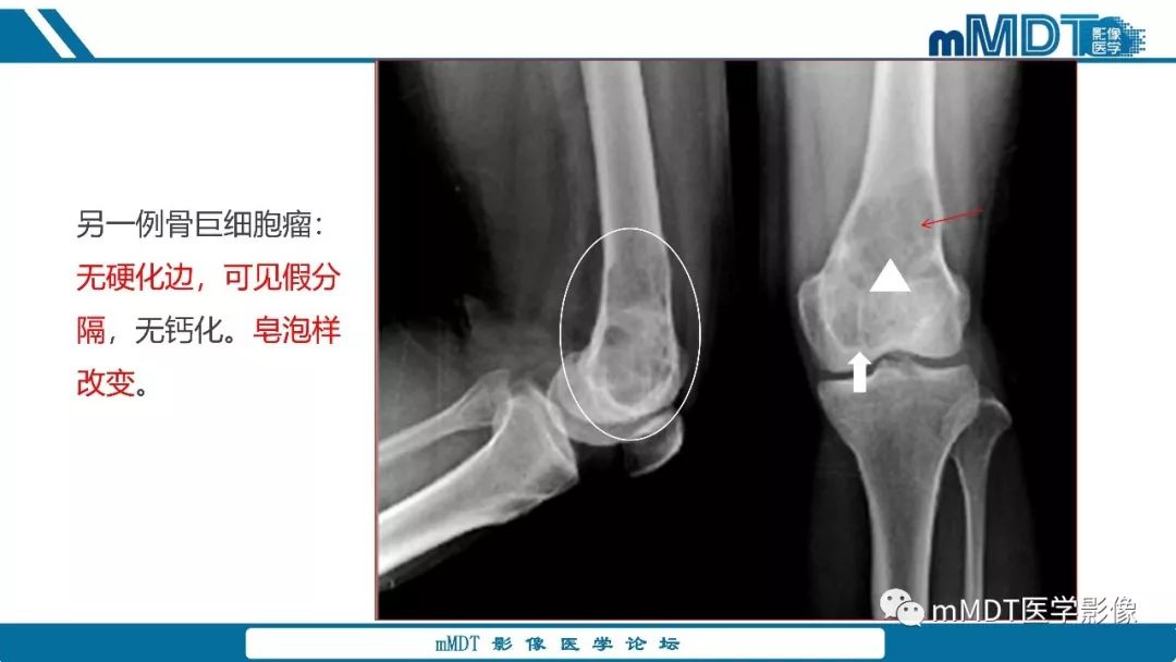 【PPT】成软骨性骨肿瘤影像诊断