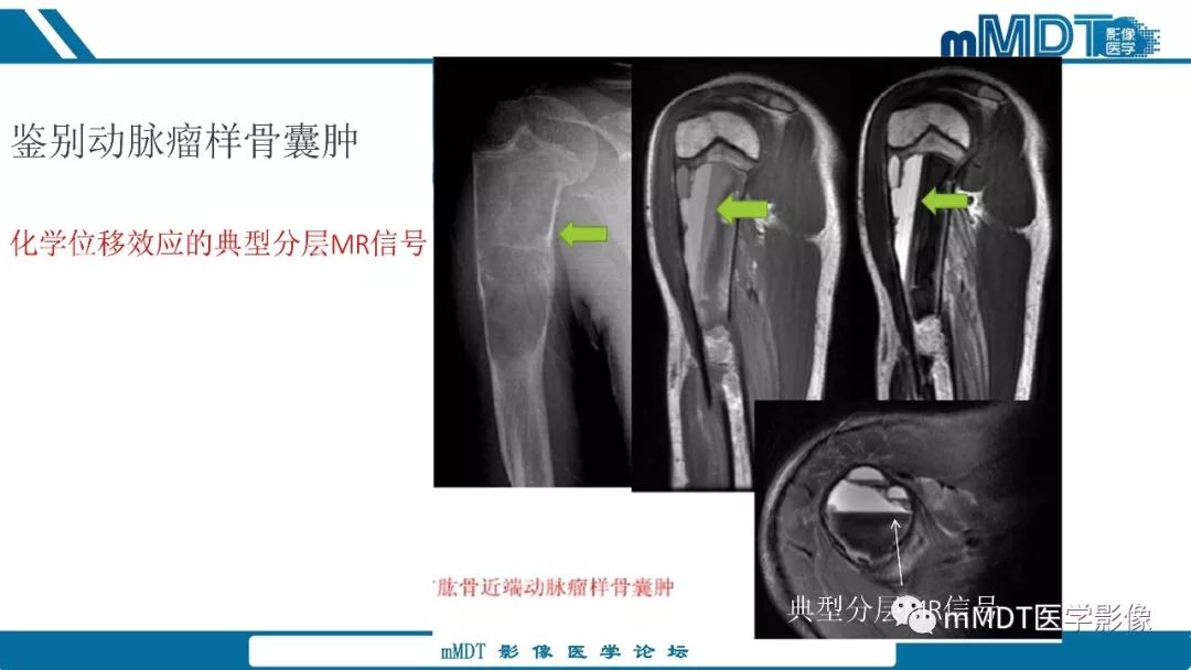 【PPT】成软骨性骨肿瘤影像诊断